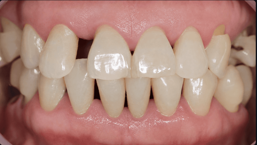Gum health visual simulation example - After